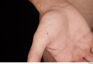 Gruffydd hand nude scar 0001.jpg